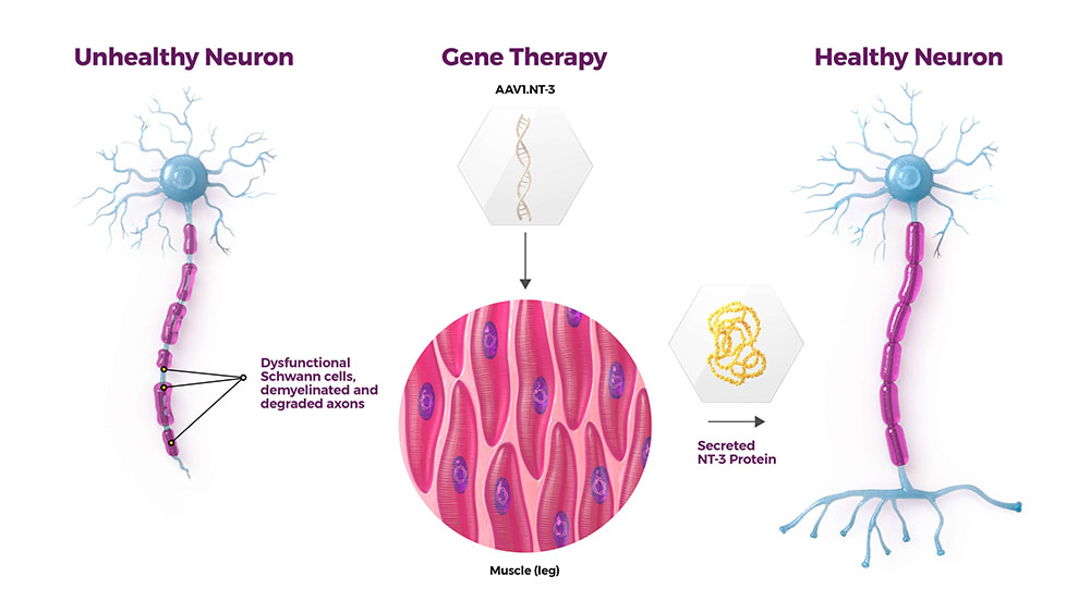 CMT neuron diagram