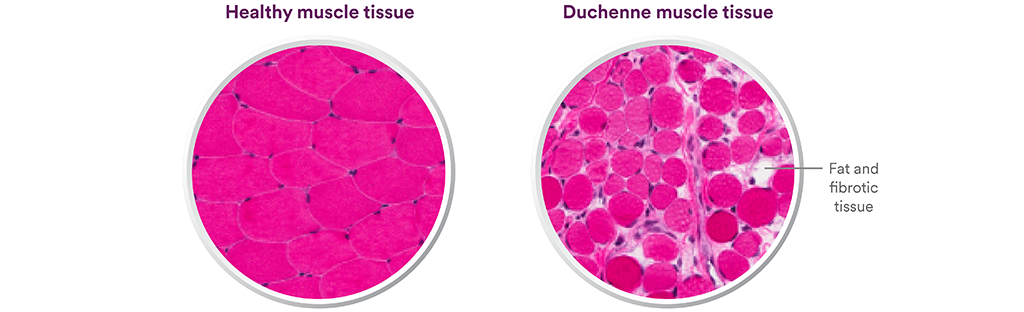 Duchenne tissue